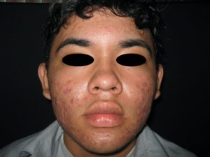 ACNE JUVENIL