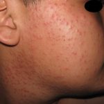 DERMATITIS ACNEIFORME