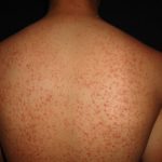 DERMATITIS ACNEIFORME