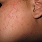 DERMATITIS ACNEIFORME