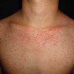 DERMATITIS ACNEIFORME