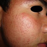 DERMATITIS ACNEIFORME