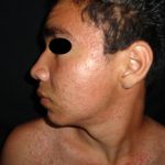 DERMATITIS ACNEIFORME