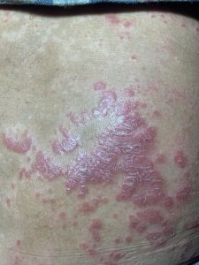 PSORIASIS