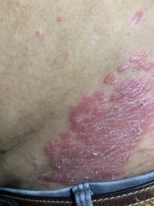 PSORIASIS