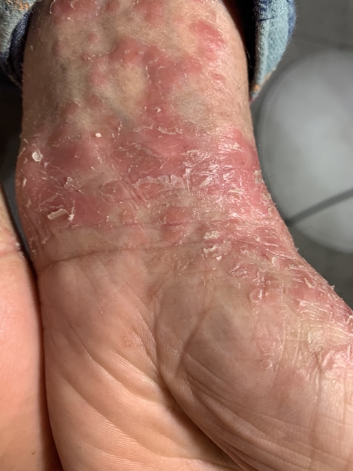 PSORIASIS