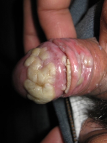 CONDILOMAS ACUMINADOS