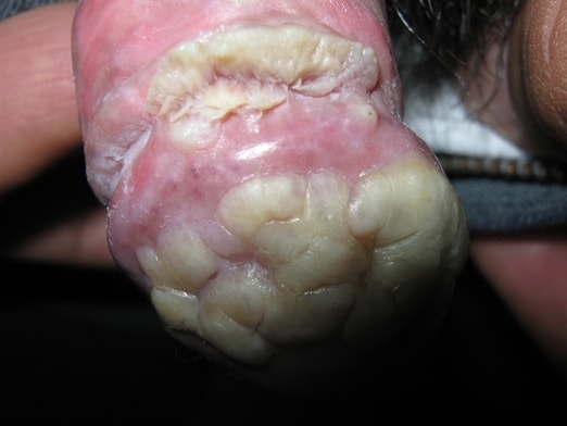 CONDILOMAS ACUMINADOS