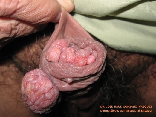 CONDILOMAS ACUMINADOS