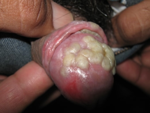 CONDILOMAS ACUMINADOS