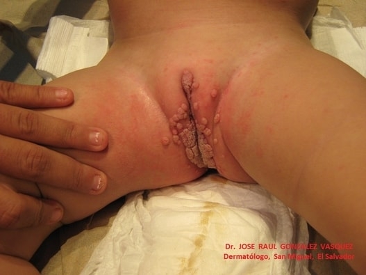 CONDILOMAS ACUMINADOS