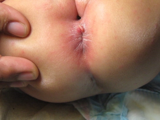 CONDILOMAS ACUMINADOS