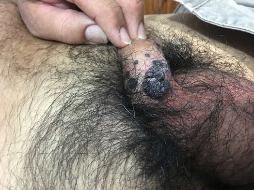 CONDILOMAS ACUMINADOS