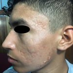 ACNE CONGLOBATA  -  ISOTRETINOINA