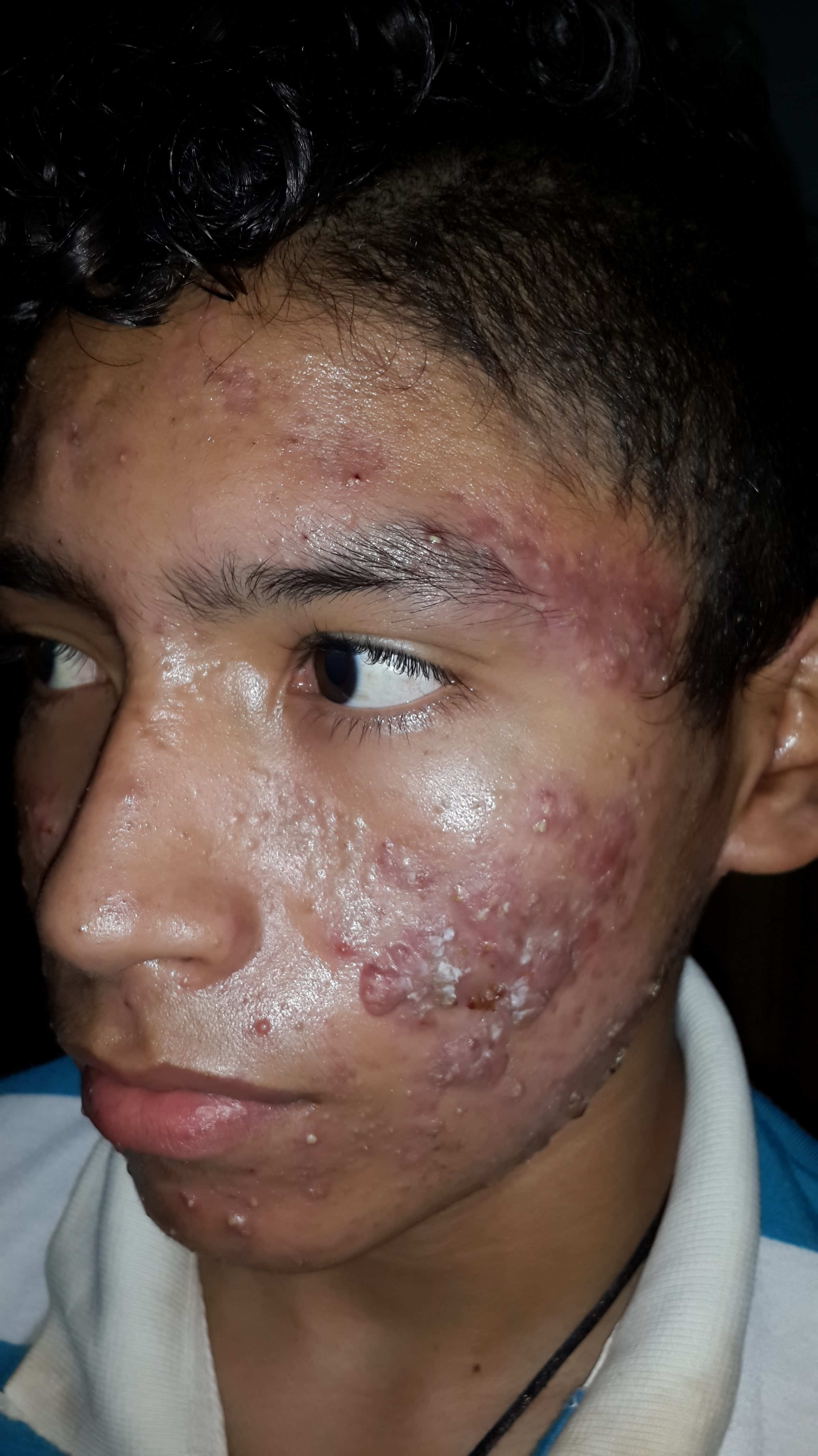 ACNE CONGLOBATA  -  ISOTRETINOINA