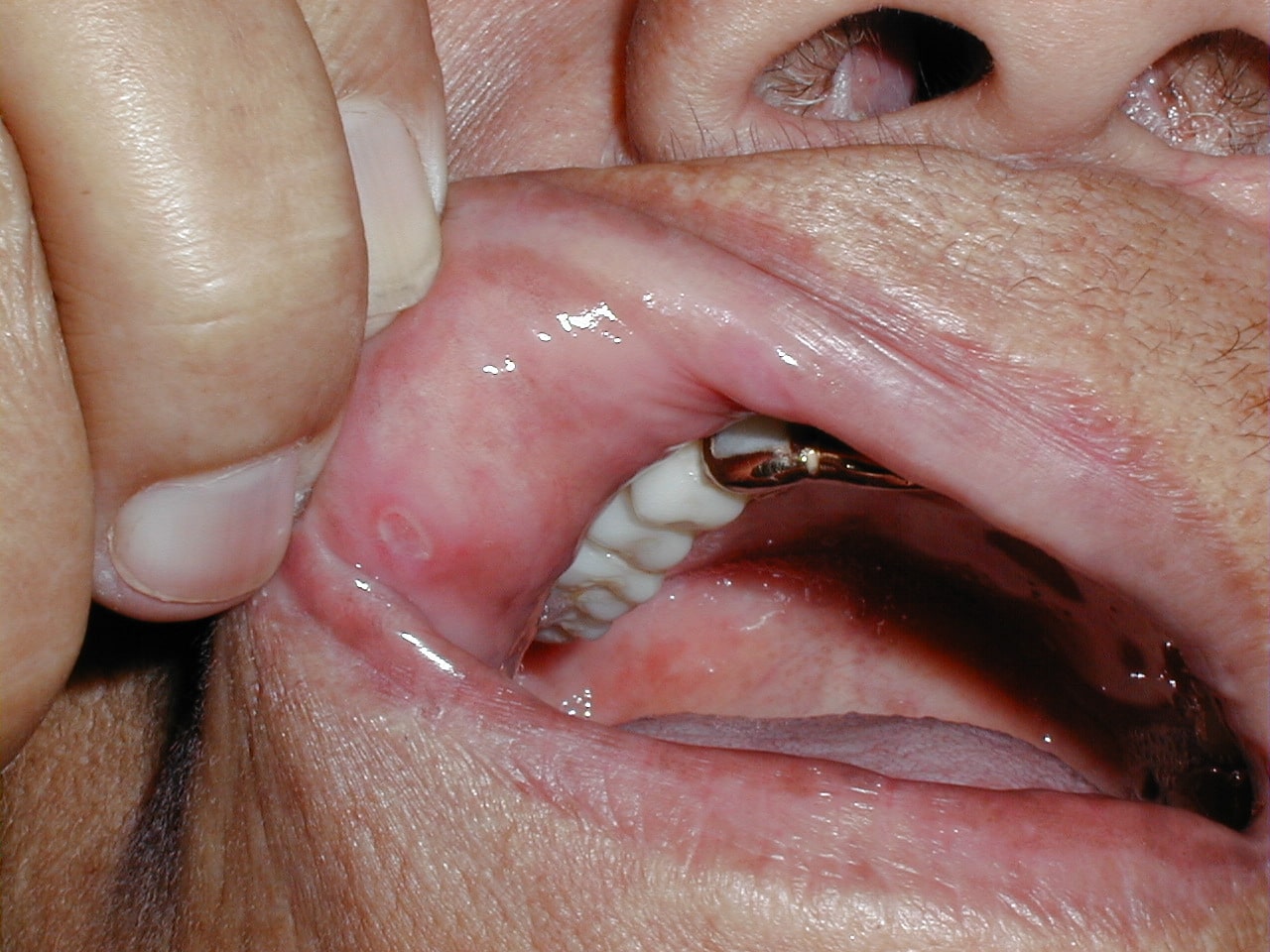 AFTAS EN MUCOSA ORAL