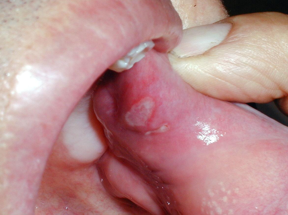 AFTAS EN MUCOSA ORAL