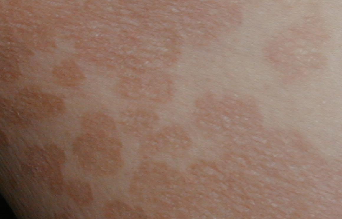 PITIRIASIS VERSICOLOR