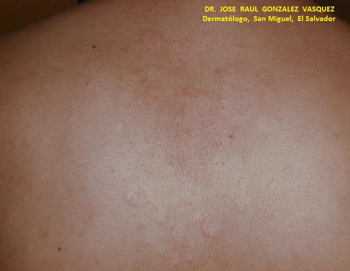 PITIRIASIS VERSICOLOR