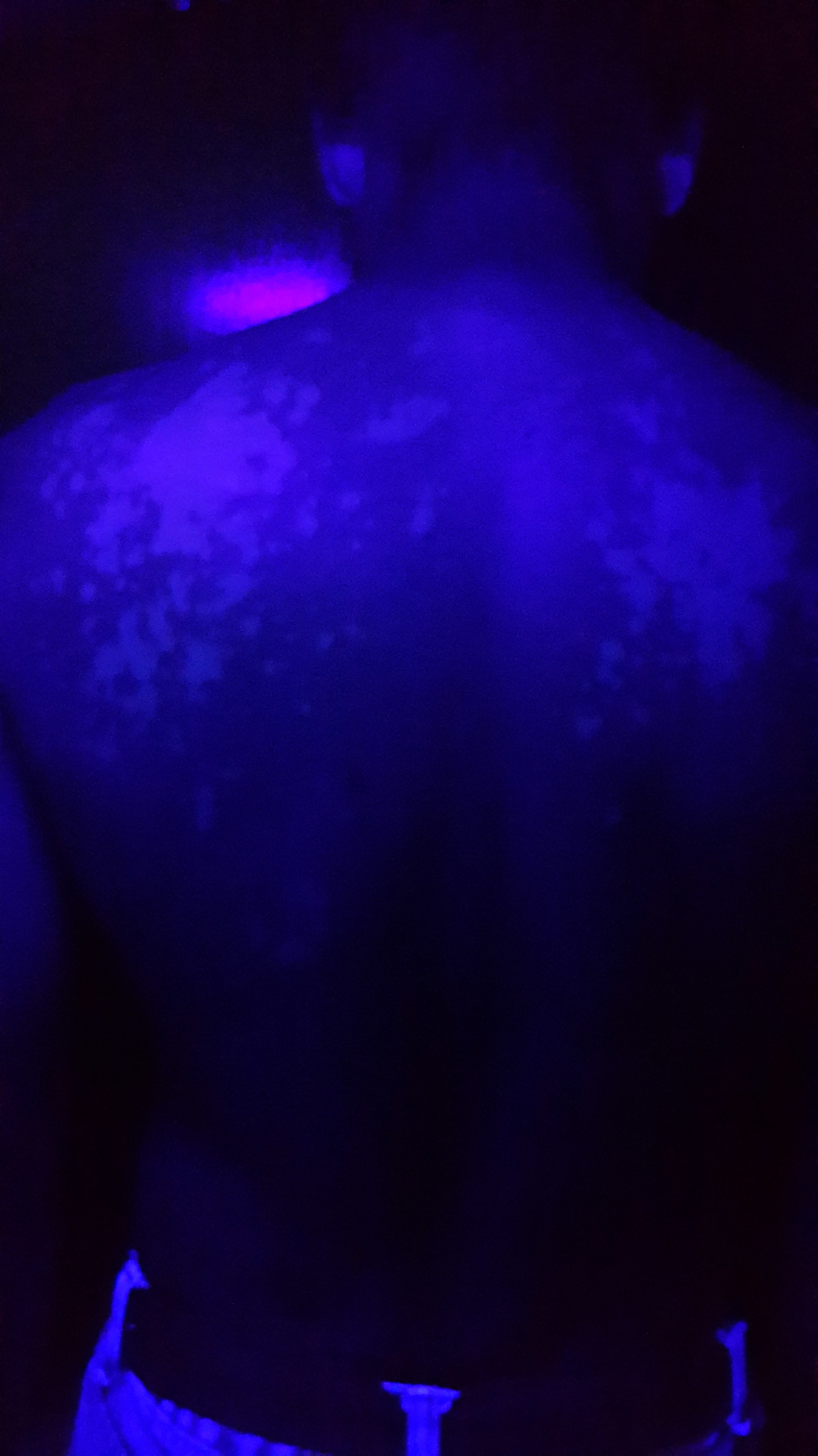 PITIRIASIS VERSICOLOR - LUZ DE WOOD