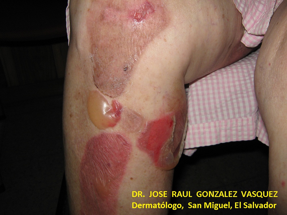 PENFIGOIDE AMPOLLOSO