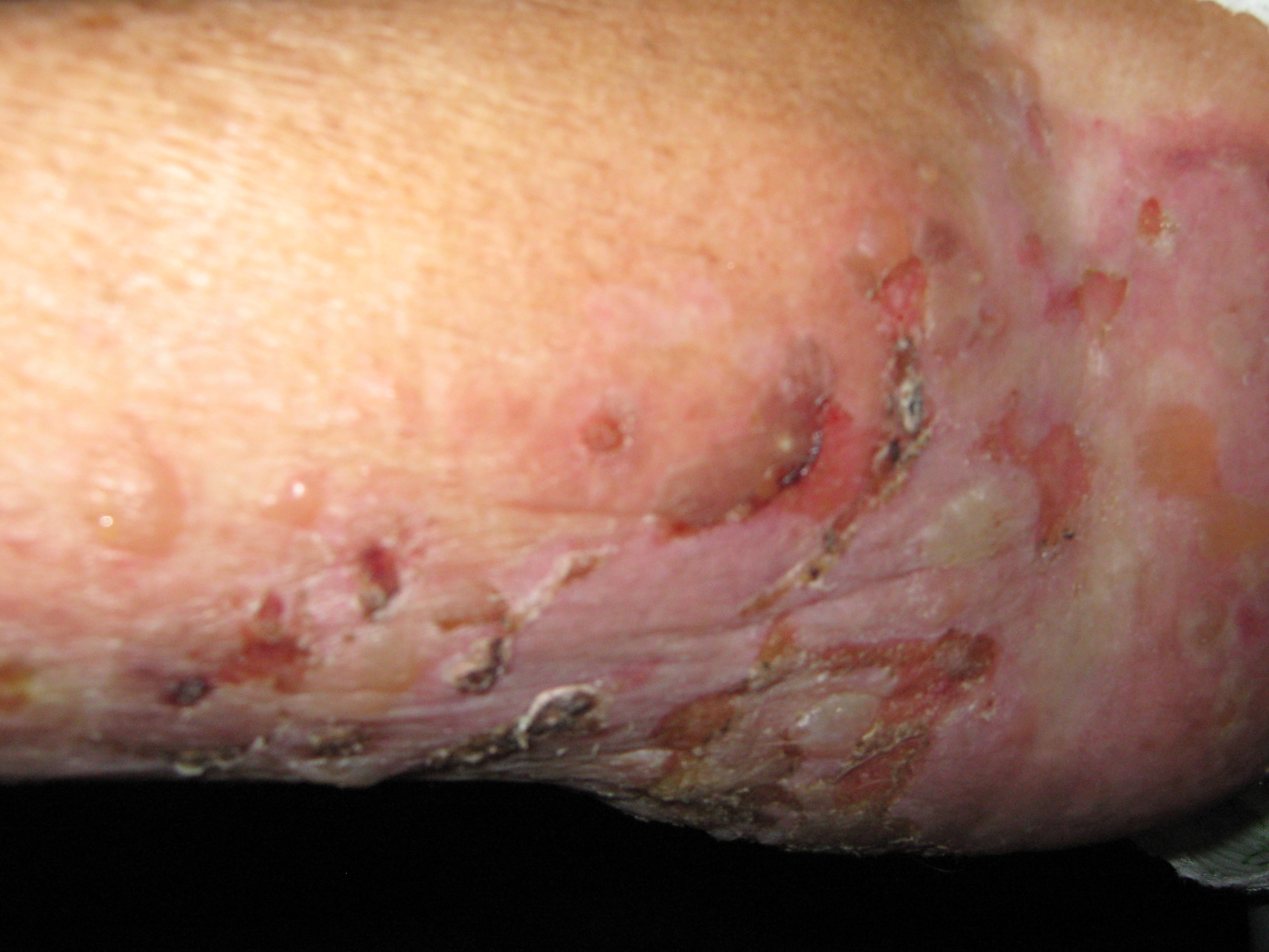 PENFIGOIDE AMPOLLOSO