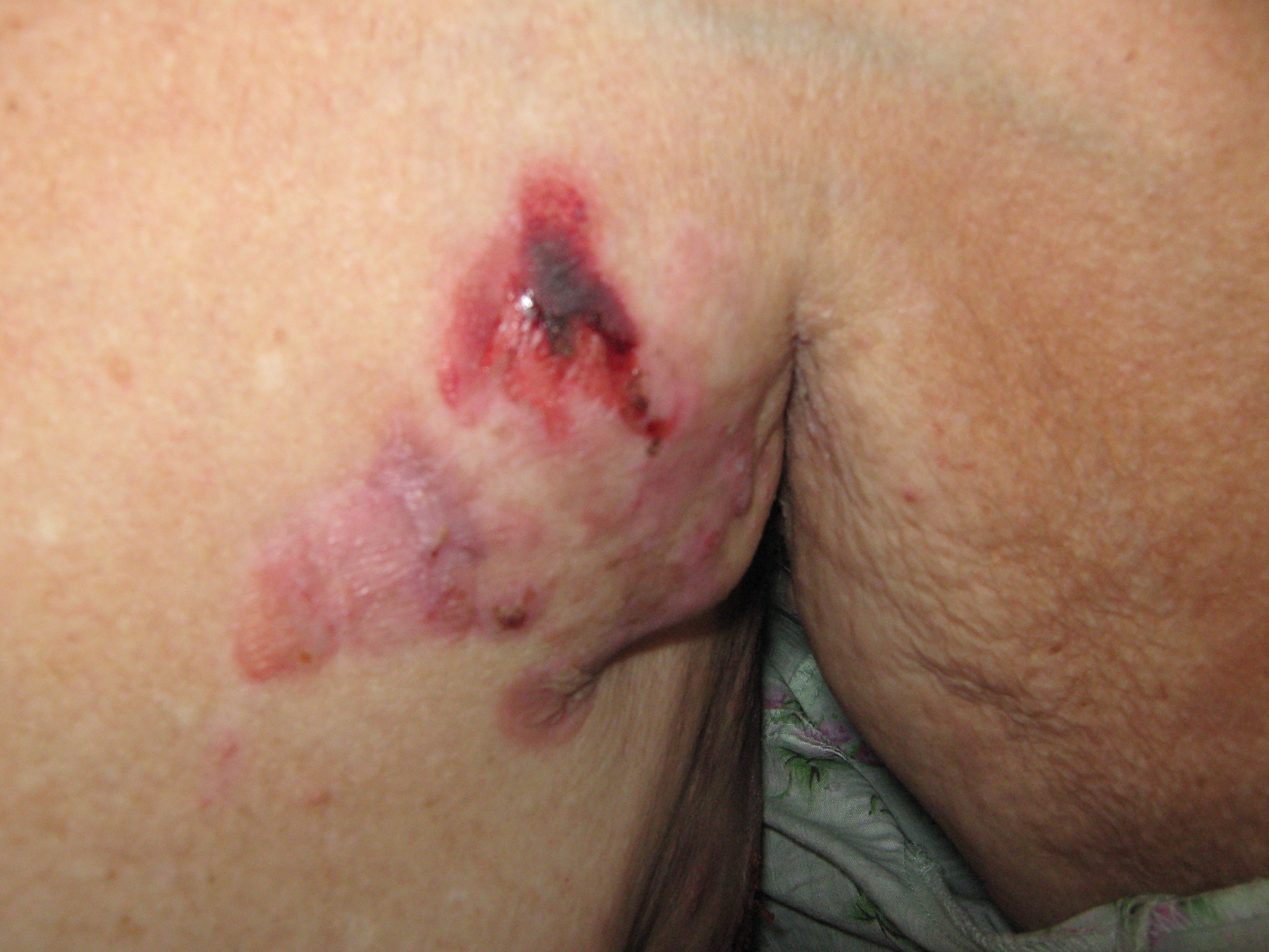 PENFIGOIDE AMPOLLOSO