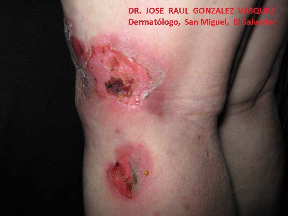 PENFIGOIDE AMPOLLOSO