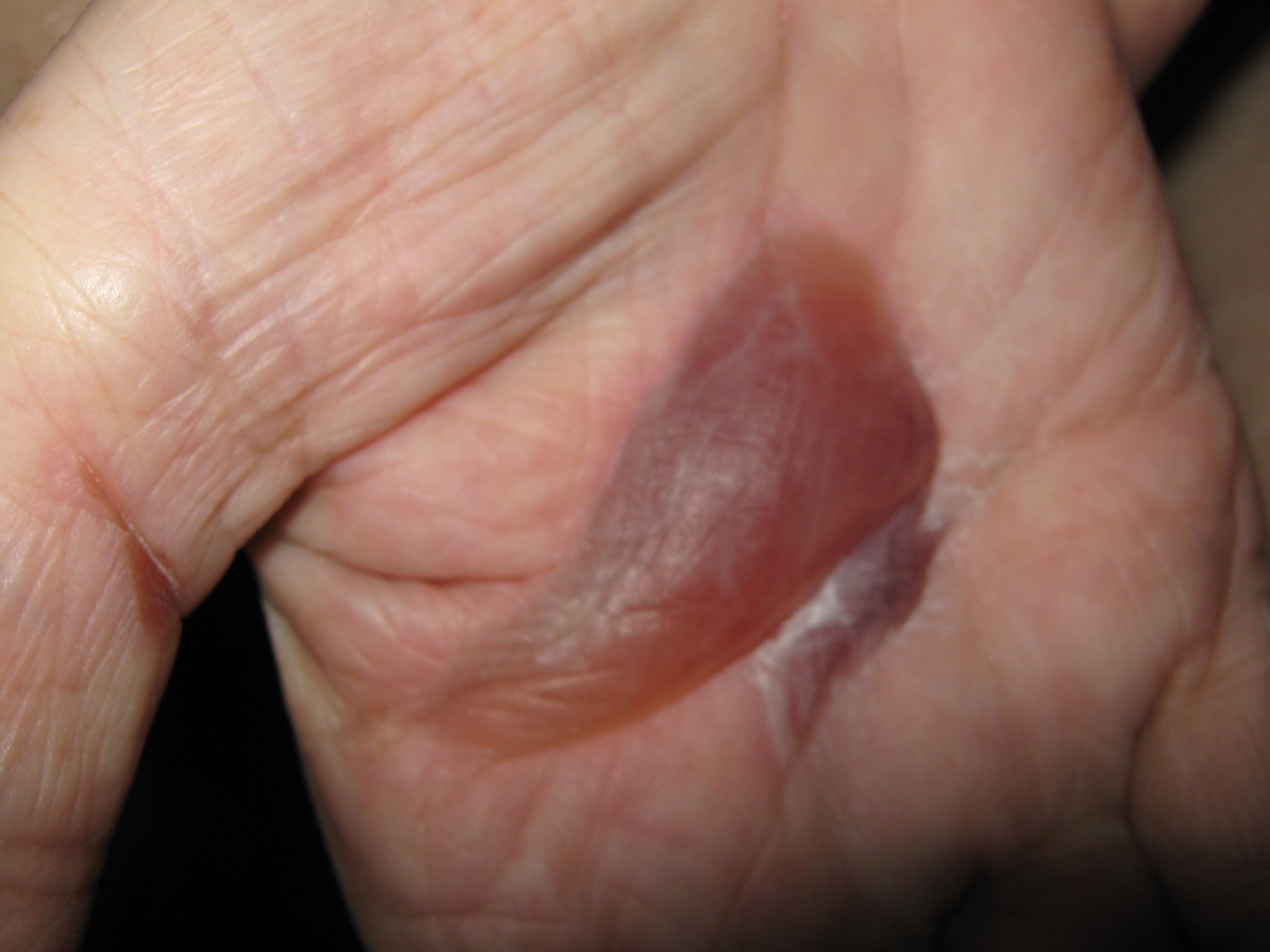 PENFIGOIDE AMPOLLOSO