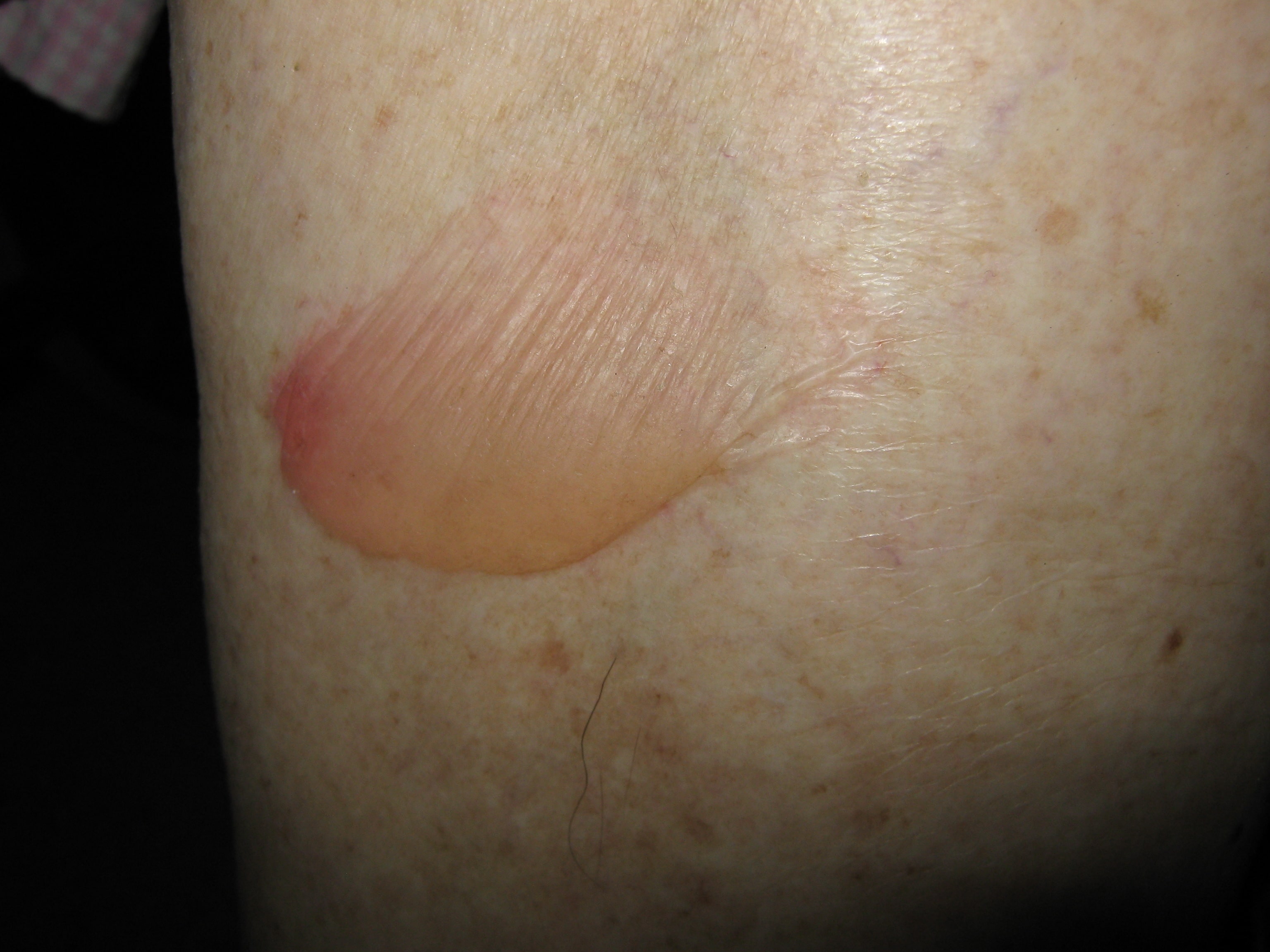 PENFIGOIDE AMPOLLOSO