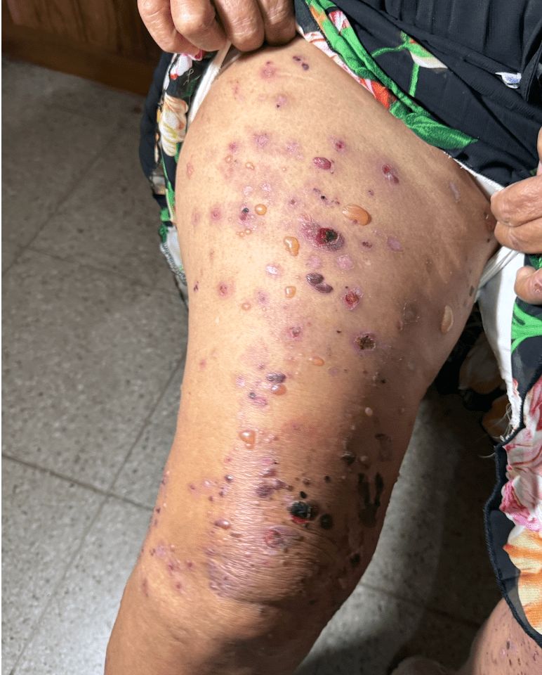 PENFIGOIDE AMPOLLOSO