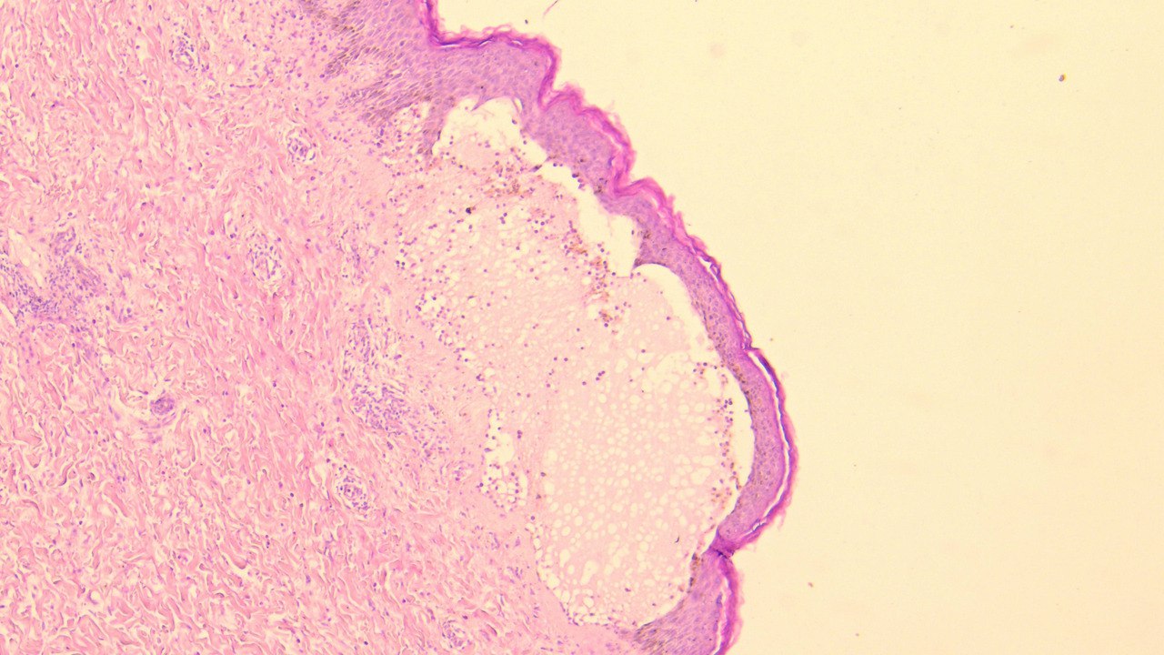PENFIGOIDE AMPOLLOSO - AMPOLLA SUBEPIDERMICA