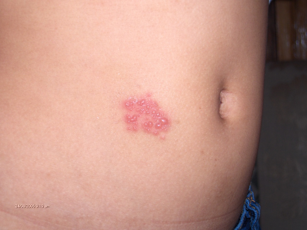 HERPES SIMPLE ABDOMEN