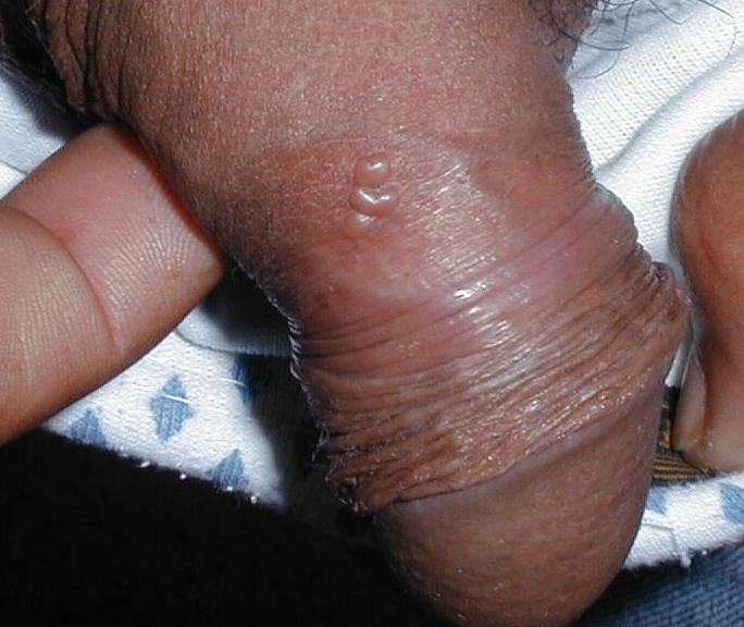 HERPES SIMPLE RECIDIVANTE EN PENE