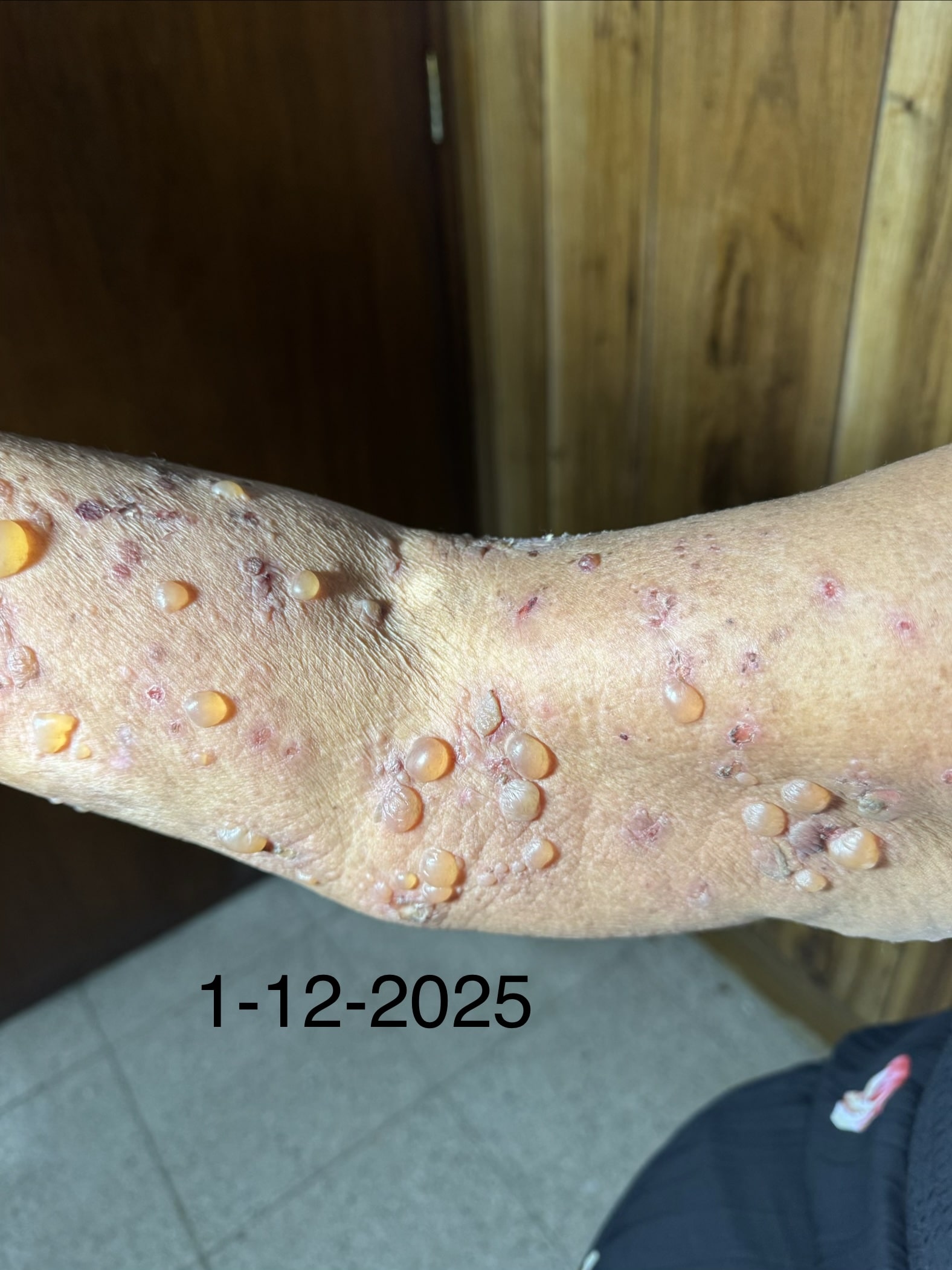 PENFIGOIDE AMPOLLOSO