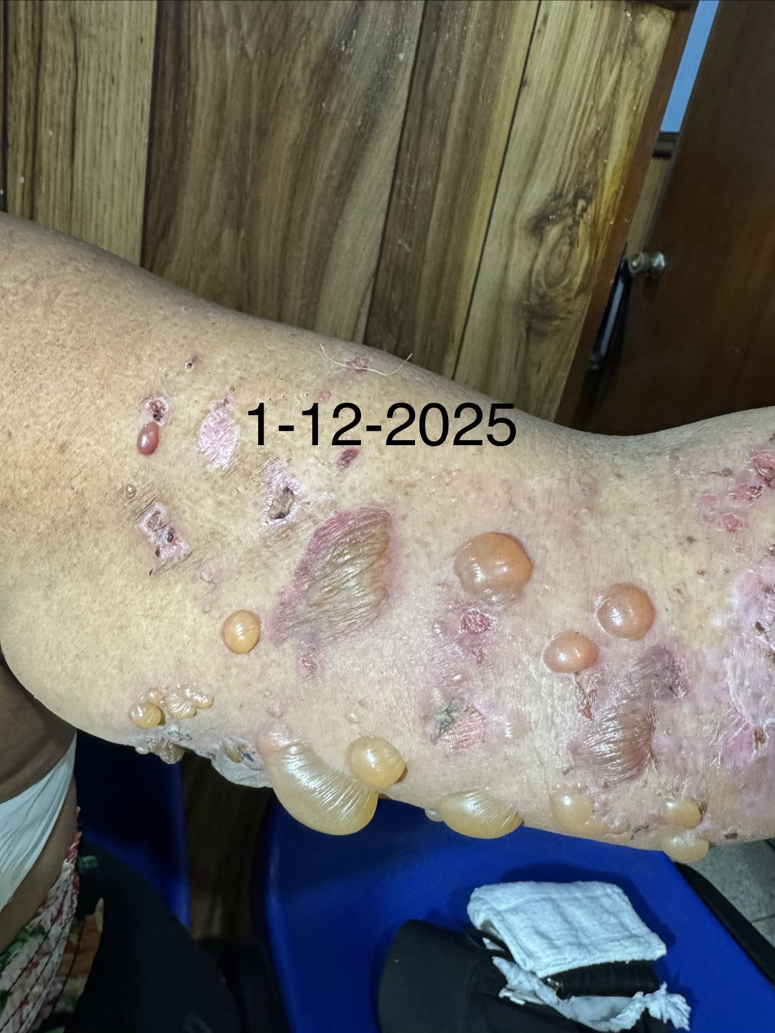 PENFIGOIDE AMPOLLOSO