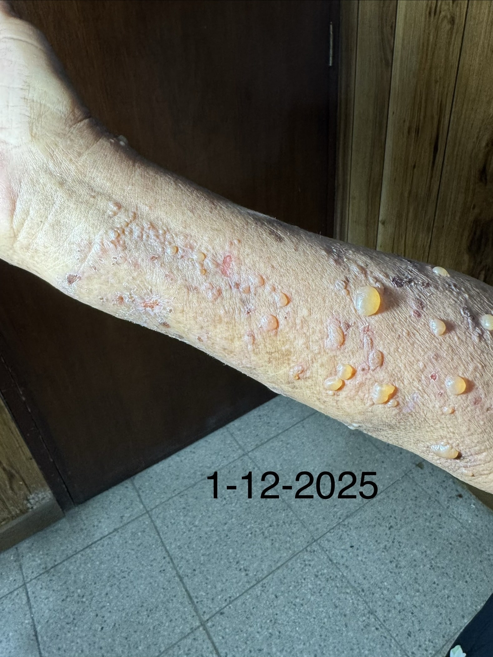 PENFIGOIDE AMPOLLOSO