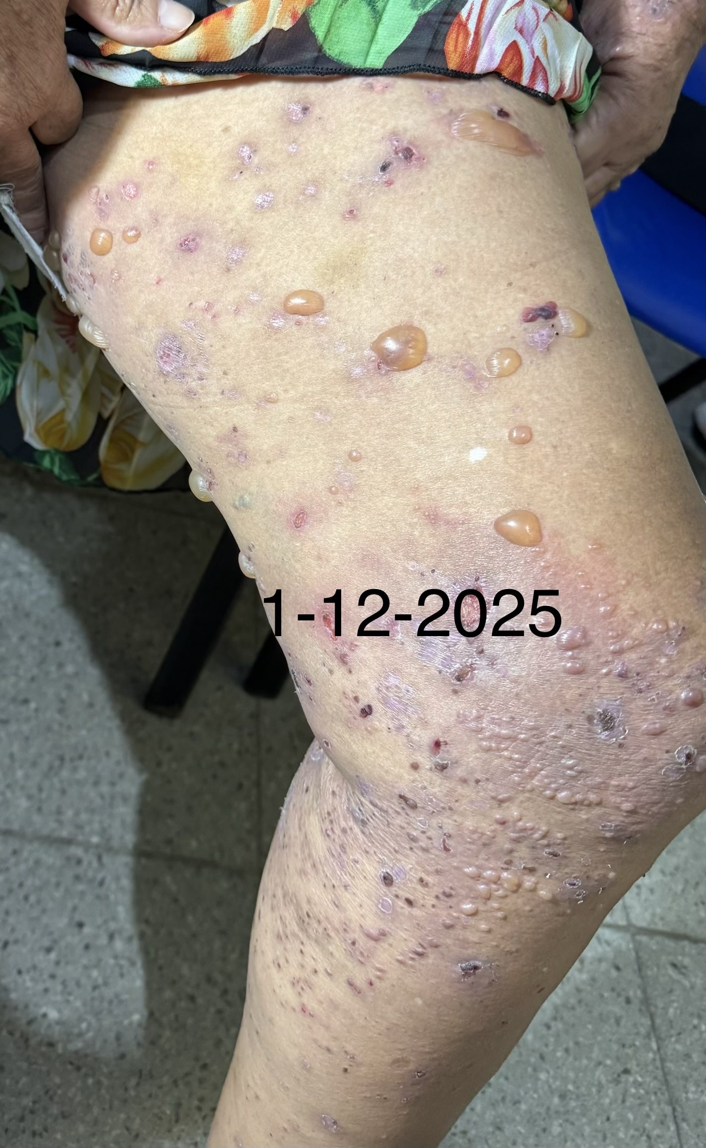 PENFIGOIDE AMPOLLOSO