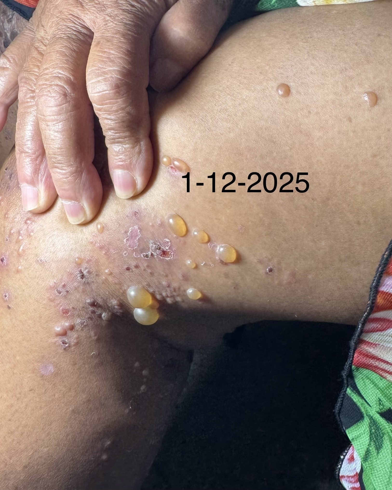 PENFIGOIDE AMPOLLOSO