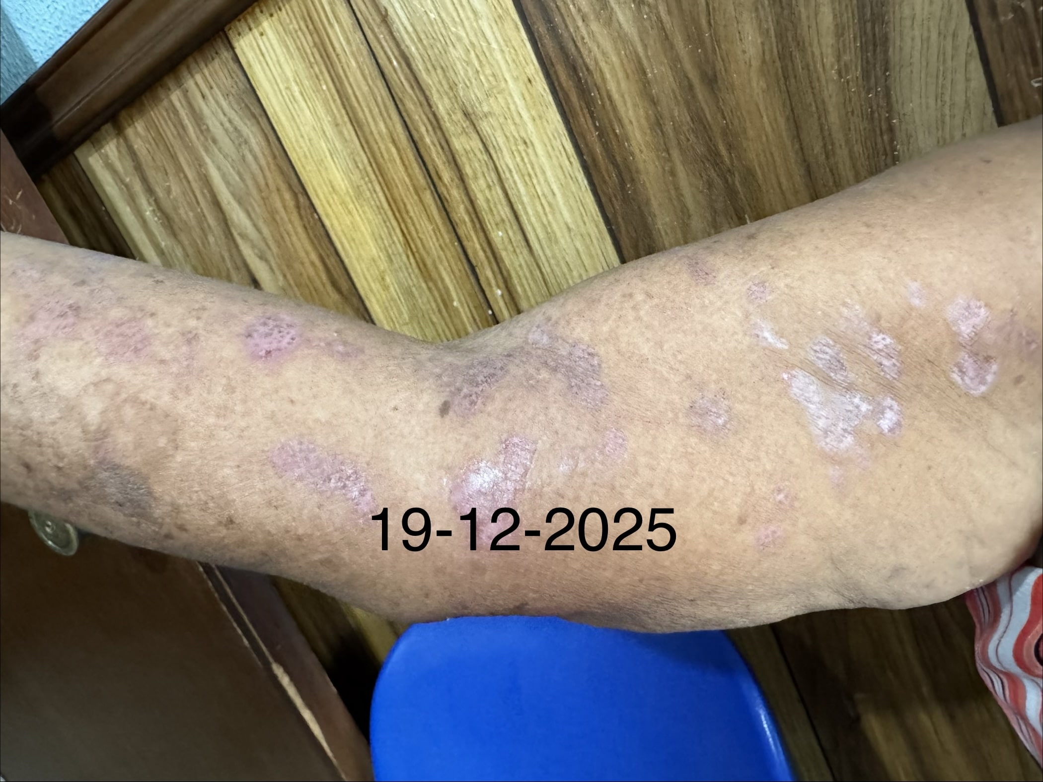 PENFIGOIDE AMPOLLOSO