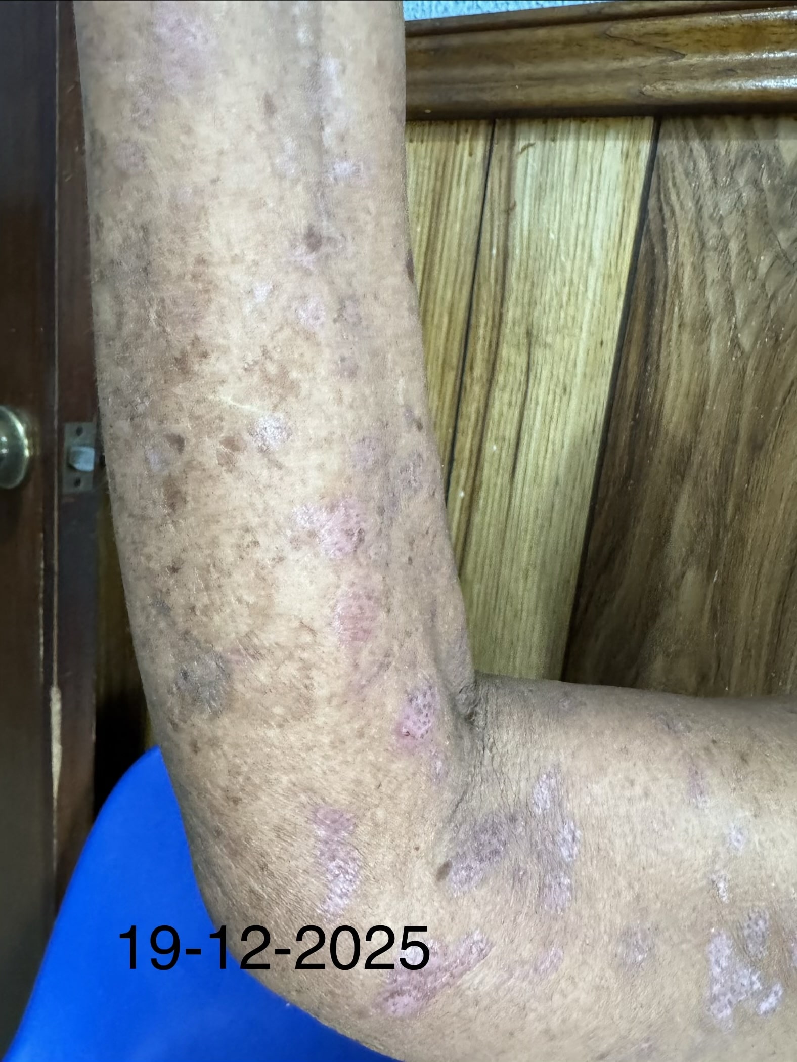 PENFIGOIDE AMPOLLOSO