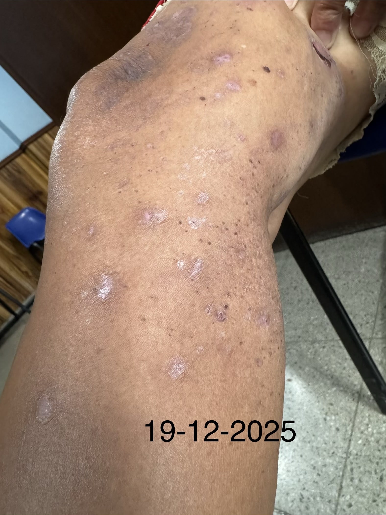 PENFIGOIDE AMPOLLOSO