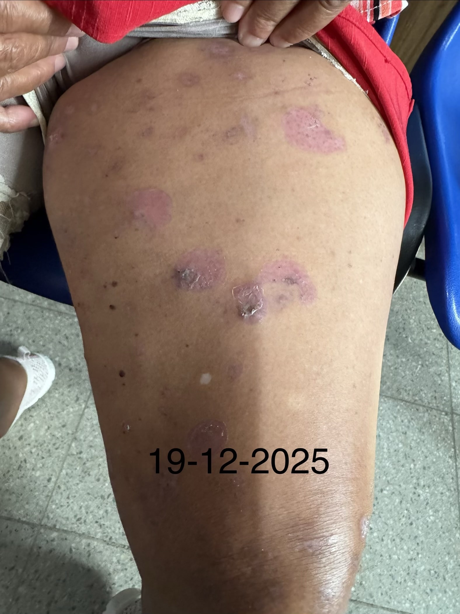 PENFIGOIDE AMPOLLOSO