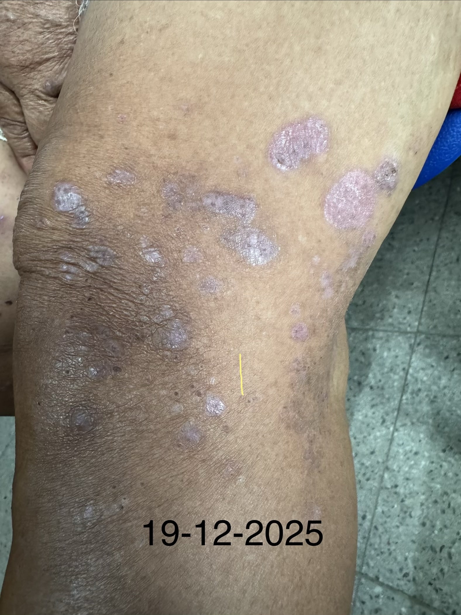 PENFIGOIDE AMPOLLOSO