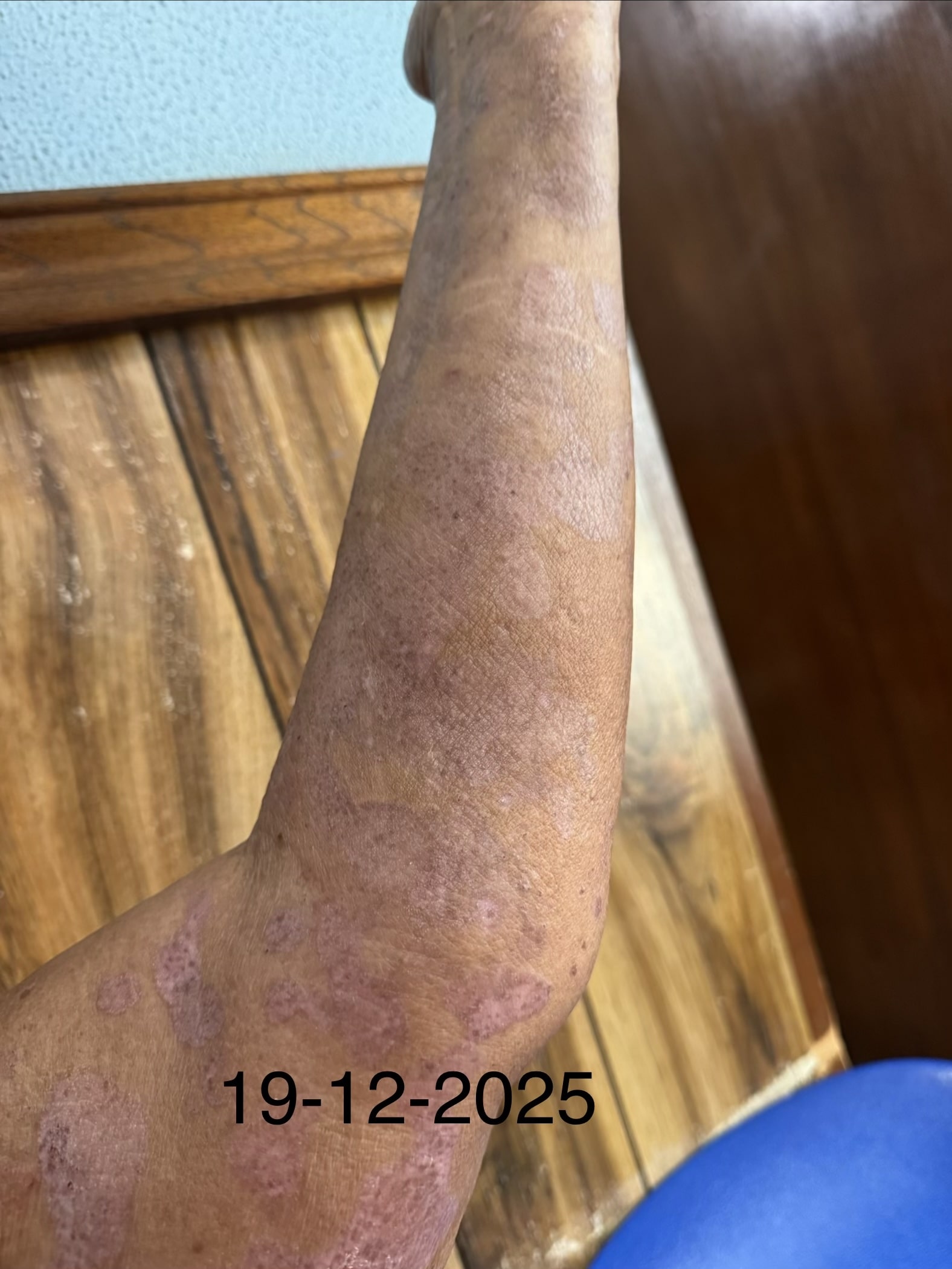 PENFIGOIDE AMPOLLOSO