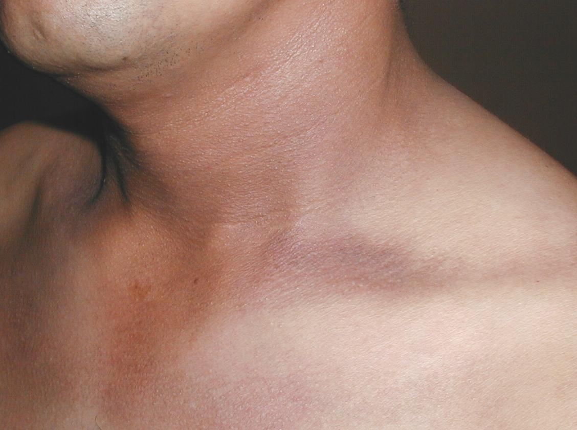 DEERMATOSIS CENICIENTA