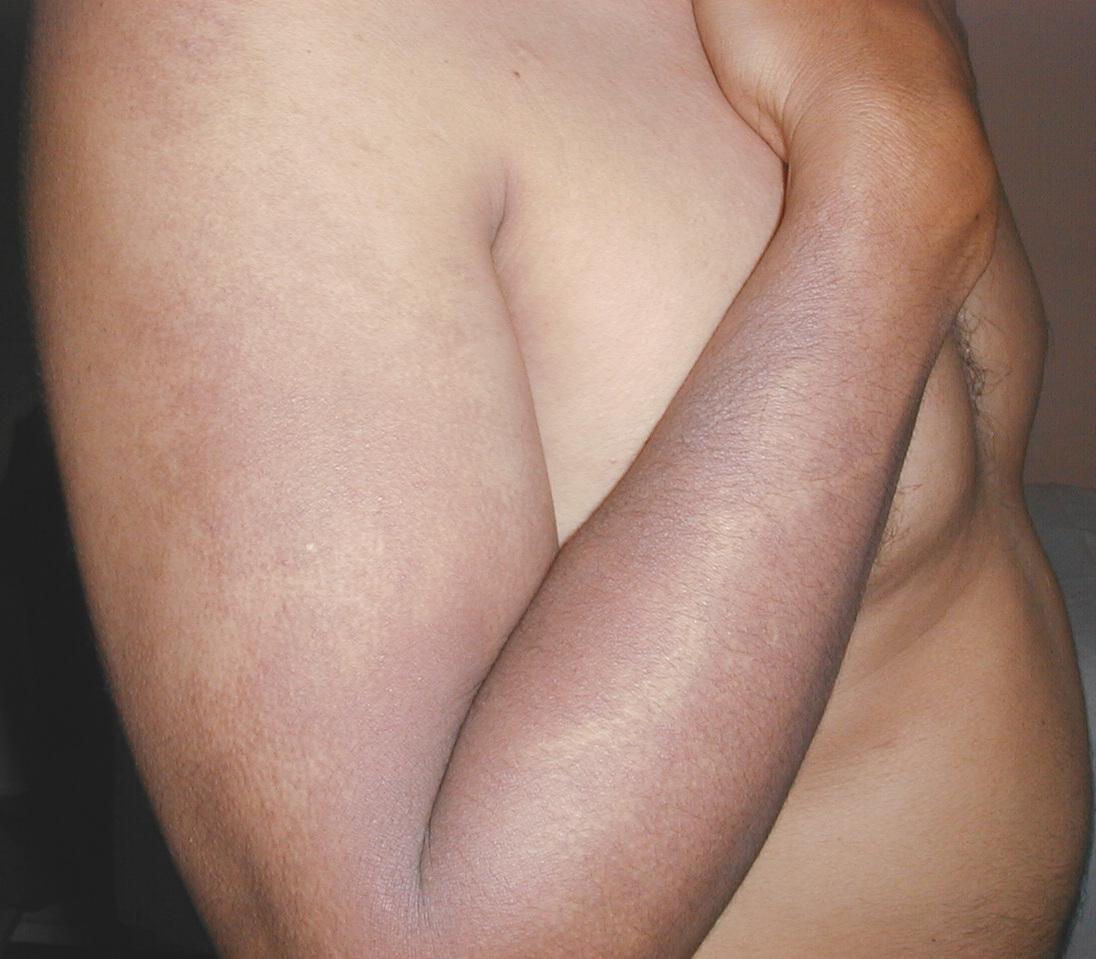 DEERMATOSIS CENICIENTA