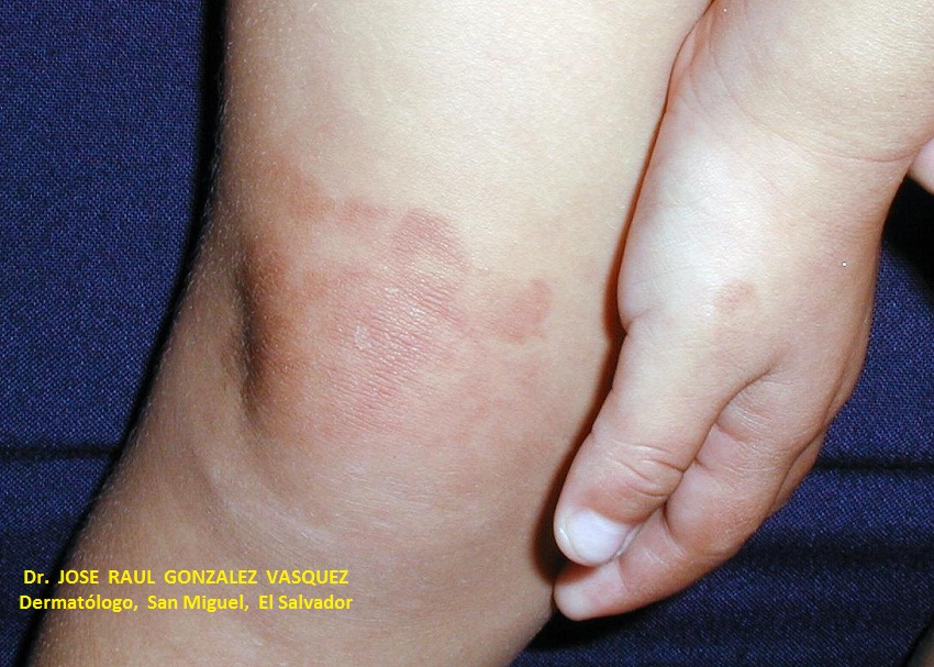 FOTOTOXICIDAD - FUROCUMARINAS