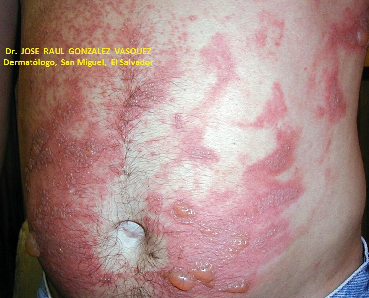 FOTOXICIDAD - FUROCUMARINAS