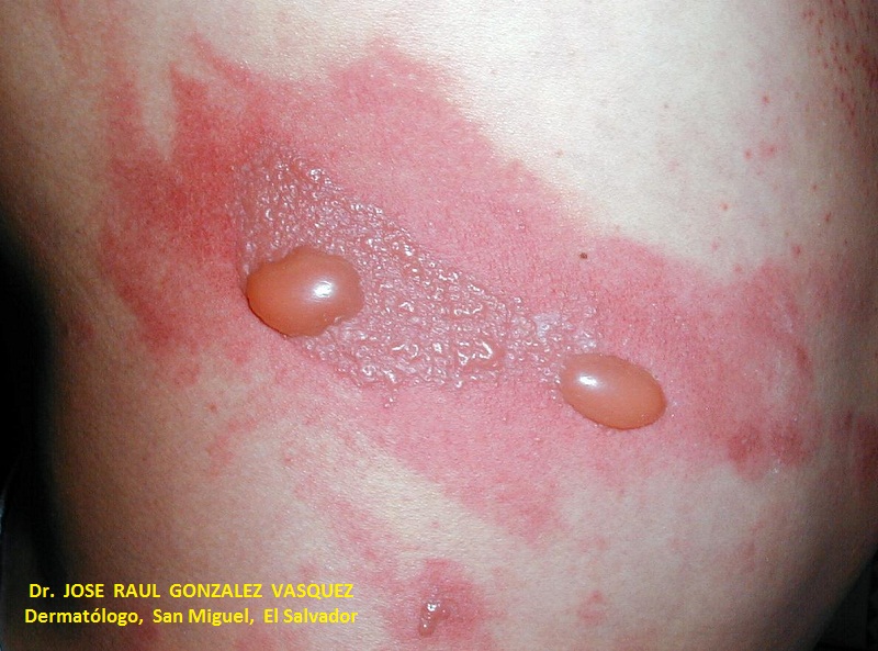 FOTOXICIDAD - FUROCUMARINAS